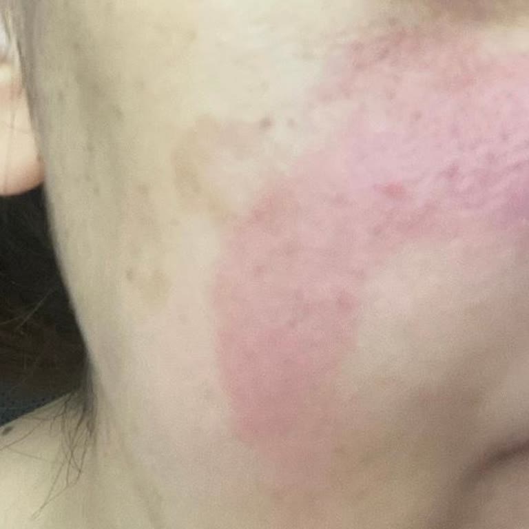 Sarı Kutulu Hametan Krem Yüzümde Kızarıklık Ve Yanma Yaptı