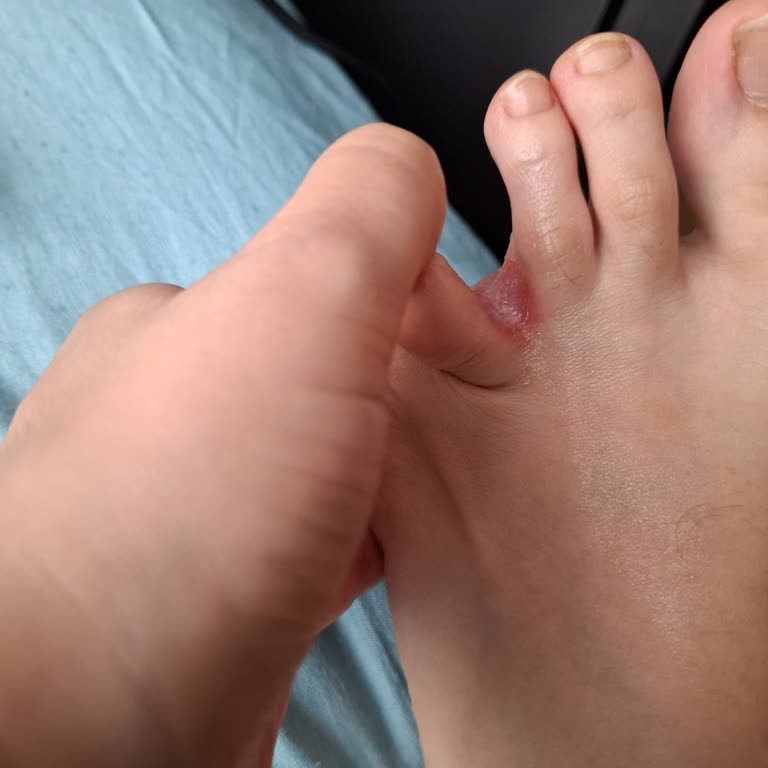 Ayak Maskesi Sonrası Ciltte Tahriş Ve Kaşıntı Sorunu