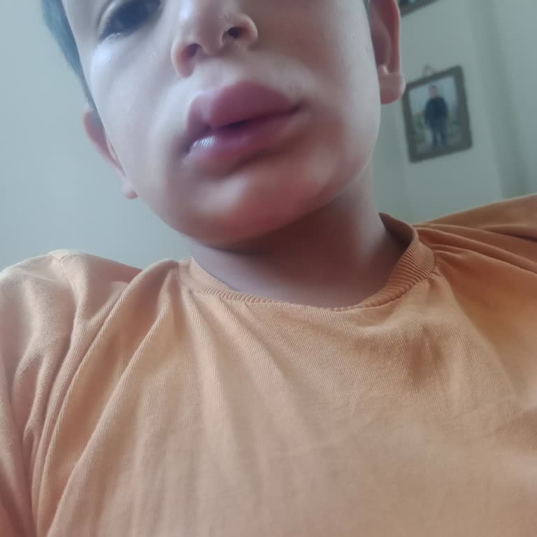 BİM Aldığım Köfte Oğlumda Ciddi Alerjik Reaksiyona Yol Açtı!