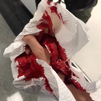 Rondo Patladı Elim Yaralandı İşimden Oldum