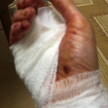 Rondo Patladı Elim Yaralandı İşimden Oldum