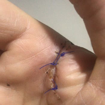 Rondo Patladı Elim Yaralandı İşimden Oldum