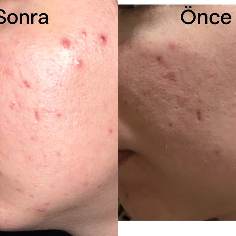 Yanlış Cilt Analizi Ve Ürün Tavsiyesi Sonucu Cilt Sorunu Yaşadım