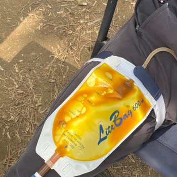 Ameliyat Sonrası Komplikasyon Ve Hastane Sorumluluğu Reddi Nedeniyle Mağduriyet