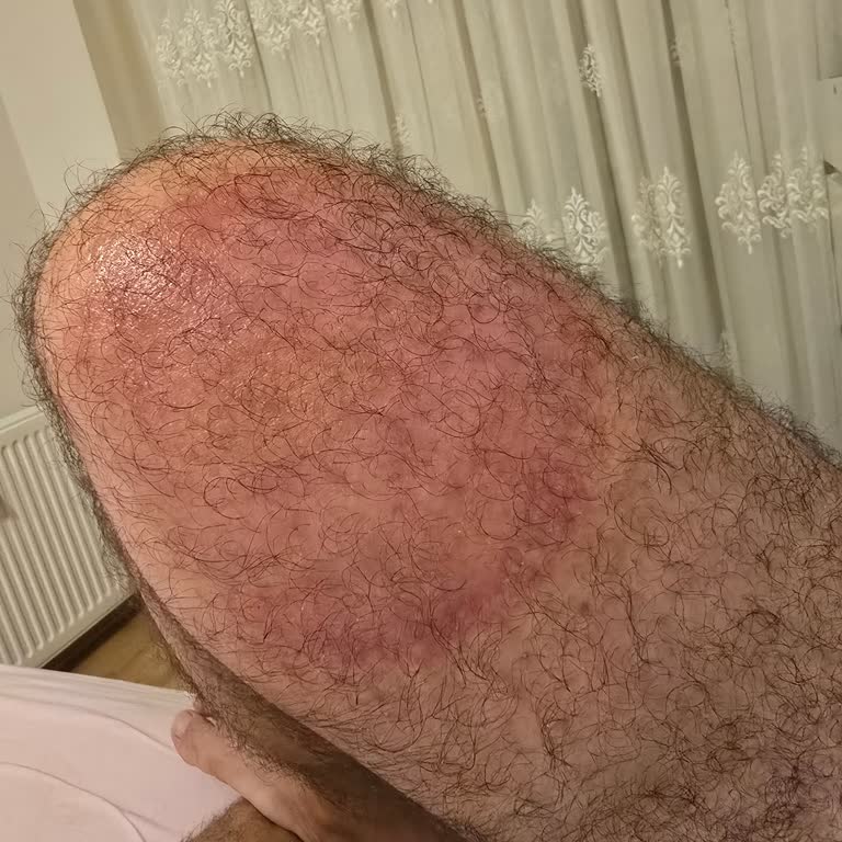 Restoranda Sıcak Çay Kazası Sonrası Yetersiz Destek Ve Mağduriyet