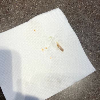 Hamburgerde Çıkan Kemik Parçası Sağlığımı Ciddi Şekilde Tehlikeye Attı