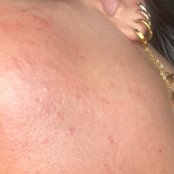 Caudalie Vinopure Gel causa acné en mi piel, solicito reembolso