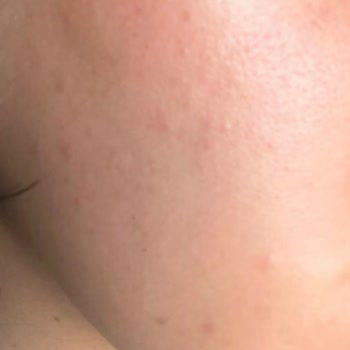 Caudalie Vinopure Gel causa acné en mi piel, solicito reembolso