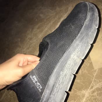 Ayakkabının Topuk Kısmı Yara Yaptı Ve Kısa Sürede Ciddi Deformasyon Oluştu