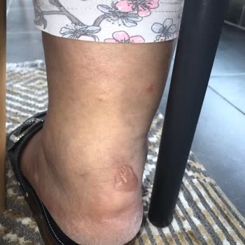 Ayakkabının Topuk Kısmı Yara Yaptı Ve Kısa Sürede Ciddi Deformasyon Oluştu