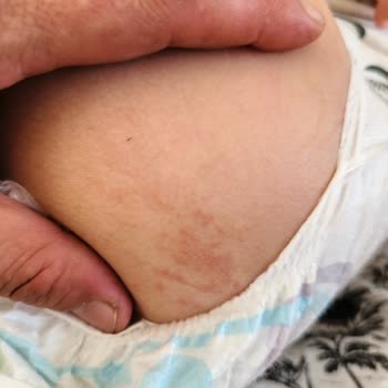 Molfix Bebek Bezinden Çıkan Yabancı Cisimler Bebeğimin Cildini Tahriş Etti