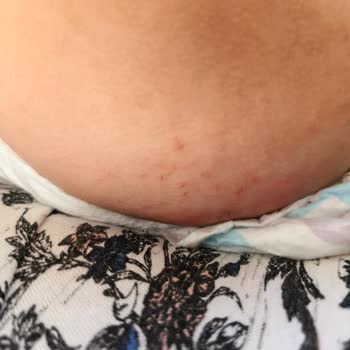 Molfix Bebek Bezinden Çıkan Yabancı Cisimler Bebeğimin Cildini Tahriş Etti