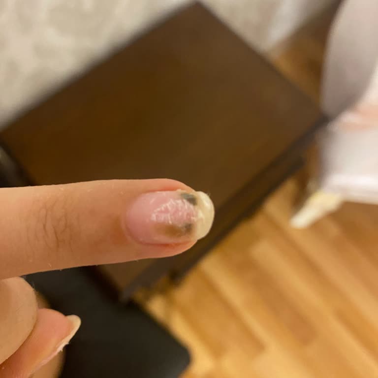 Tırnak Uygulaması Sonrası Ciddi Sağlık Sorunu Yaşadım