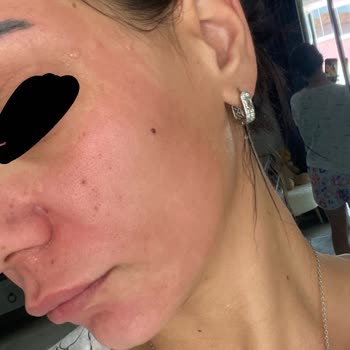 Peeling Ürünü Yüzümde Yanma Ve Kızarıklığa Sebep Oldu, Mağduriyetimin Giderilmesini Talep Ediyorum
