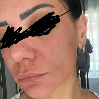 Peeling Ürünü Yüzümde Yanma Ve Kızarıklığa Sebep Oldu, Mağduriyetimin Giderilmesini Talep Ediyorum