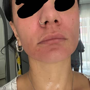 Peeling Ürünü Yüzümde Yanma Ve Kızarıklığa Sebep Oldu, Mağduriyetimin Giderilmesini Talep Ediyorum