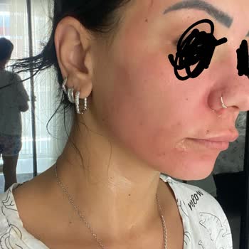 Peeling Ürünü Yüzümde Yanma Ve Kızarıklığa Sebep Oldu, Mağduriyetimin Giderilmesini Talep Ediyorum