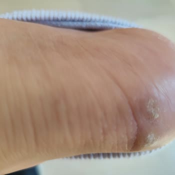 Satın Alınan Ayakkabının Kısa Sürede Deforme Olması Ve Garanti Talebinin Reddedilmesi