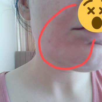 I Face Burning And Redness After Using L’Oréal Paris Sunscreen Face Cream