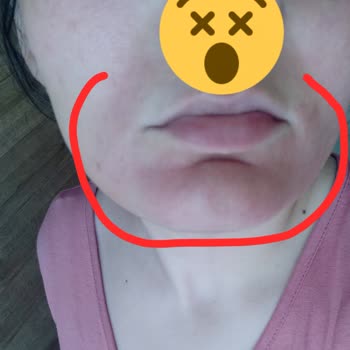 I Face Burning And Redness After Using L’Oréal Paris Sunscreen Face Cream