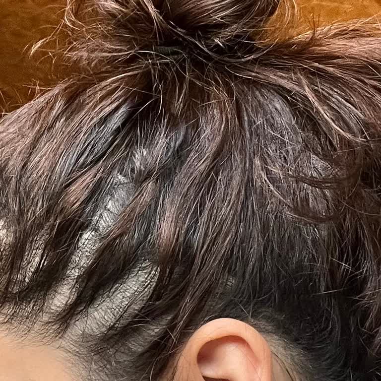 I Face Severe Hair Loss After Using L’Oréal Elseve Glycolic Gloss Shampoo And Lamination