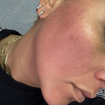 I Face Burning And Stinging Reaction After Using L’Oréal Paris Moisturizing Sun Protection Cream