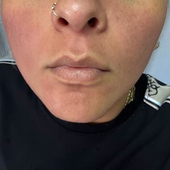 I Face Burning And Stinging Reaction After Using L’Oréal Paris Moisturizing Sun Protection Cream