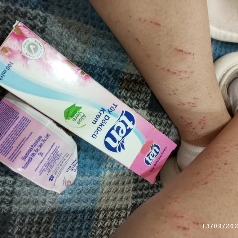 Ten Tüy Dökücü Krem Cildimde Yaralar Yaptı