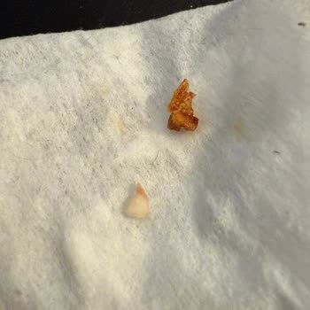 Dana Sosis İçinde Çıkan Kemik Parçaları Dişimi Kırıyordu