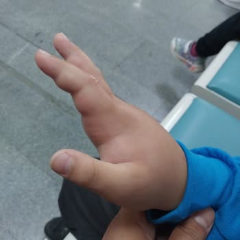 Böcek Isırığı Ve Hijyen Sorunları Nedeniyle Mağduriyet Yaşadık