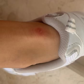 Aldığım Ayakkabının Orijinalliğinden Şüpheliyim Ve Ayağımı Yaraladı