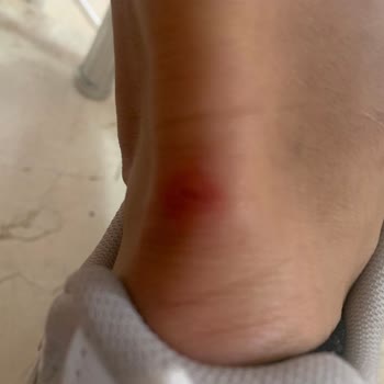 Aldığım Ayakkabının Orijinalliğinden Şüpheliyim Ve Ayağımı Yaraladı