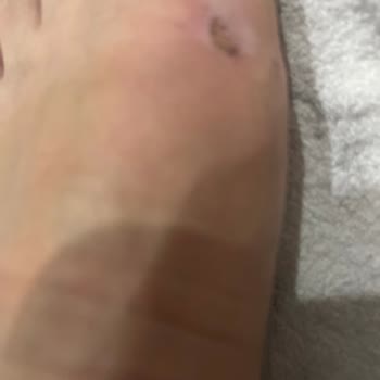 Orijinal Olmayan Ayakkabı Ve Ciddi Ayak Yaralanmaları Nedeniyle İade Talebi