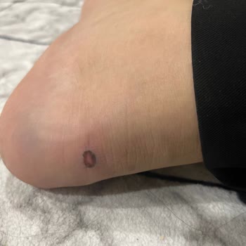 Orijinal Olmayan Ayakkabı Ve Ciddi Ayak Yaralanmaları Nedeniyle İade Talebi