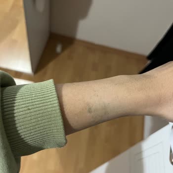 Aldığım Saatte Cilt Sorunu Ve Yetersiz Müşteri Hizmeti