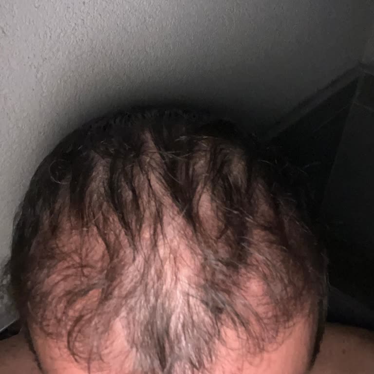 Saç Ekimi Sonrası Yanlış Uygulama Ve Ücret İadesi Sorunu