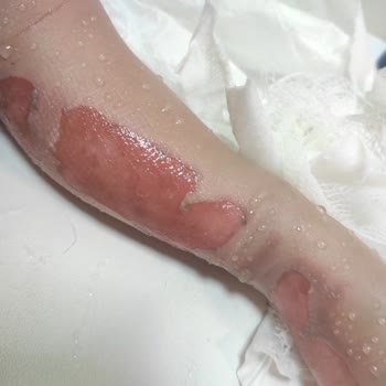 Stanley Termos Patladı: Güvenlik Açığı Ve Ciddi Yanıklar