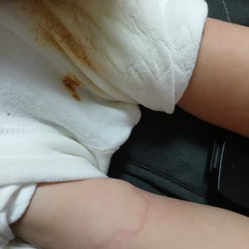 Sinek Kovucu Krem Ciddi Alerjik Reaksiyona Sebep Oldu