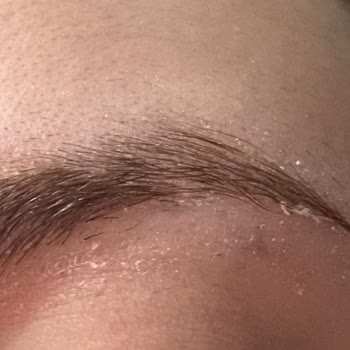 Son Kullanma Tarihi Geçmiş Ürün Nedeniyle Sağlık Sorunu Ve Destek Eksikliği