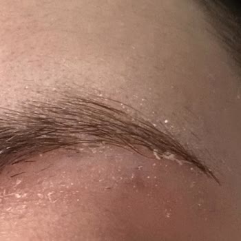 Son Kullanma Tarihi Geçmiş Ürün Nedeniyle Sağlık Sorunu Ve Destek Eksikliği