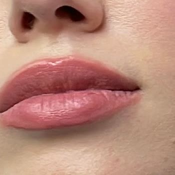 Estetik Klinik Tedavisi Sonrası Cilt Sorunlarım Arttı, Ücret İadesi Talep Ediyorum