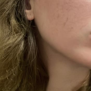 Estetik Klinik Tedavisi Sonrası Cilt Sorunlarım Arttı, Ücret İadesi Talep Ediyorum