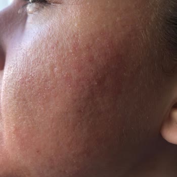 Neutrogena Gel Antiacné me provocó ardor, enrojecimiento y Hinchazón Facial