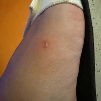 Kısa Sürede Deforme Olan Sandalet Ayağımı Yaraladı