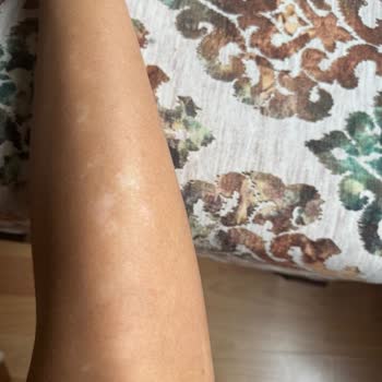 Lazer İşlemi Sonrası Kalıcı Cilt Hasarı Ve Ücret İadesi Mağduriyeti