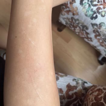 Lazer İşlemi Sonrası Kalıcı Cilt Hasarı Ve Ücret İadesi Mağduriyeti