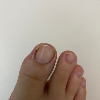 Pedikür Sonrası Sağlık Sorunları Ve İlgisiz İşletme Yaklaşımı