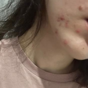 Yves Rocher Ürünleri Cildimde Sivilce Sorunu Oluşturdu, İade Talebime Yanıt Alamıyorum