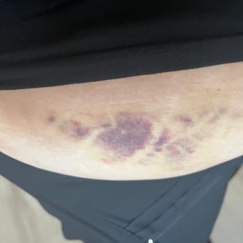 Suit Güzellik Merkezi'nde Sağlık Sorunu Ve Ücret İadesi Mağduriyeti