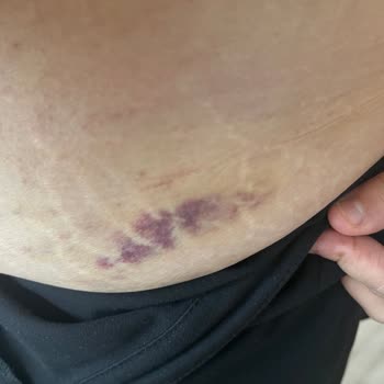 Suit Güzellik Merkezi'nde Sağlık Sorunu Ve Ücret İadesi Mağduriyeti